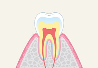 虫歯の進行と症状 イメージ画像1