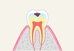 虫歯の進行と症状 イメージ画像2