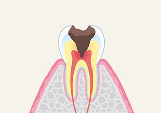 虫歯の進行と症状 イメージ画像4