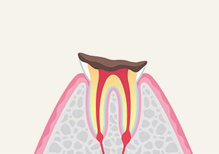 虫歯の進行と症状 イメージ画像5
