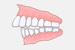 不正咬合の種類 イメージ画像1