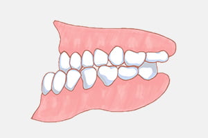 不正咬合の種類 イメージ画像2