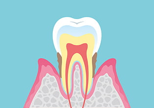 中度（症状：歯ぐきの発赤や腫脹、出血、口臭、歯の動揺） イメージ画像