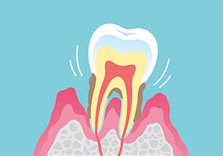 重症（症状：歯ぐきが発赤や腫脹、出血、口臭、歯の動揺、排膿） イメージ画像